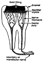 Figure 1 Puharich tooth radio receiver. Signals are received by the gold filling, converted to electric signals in the audio frequency range by the rectifier crystal, and imparted directly to the nerve endings of the live tooth. Drawing from US Patent 2 995 663 