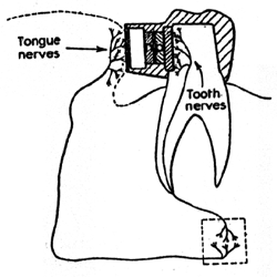 Figure 3 By 1964, Puharich had improved the amplifier so that it could be mounted on the back of the tooth. In this drawing, the amplifier "is greatly exaggerated in size to facilitate description" and would, in fact, be hidden under the tooth cap. The amplifier has a terminal on the left which must be touched with the tongue to complete the circuit. Drawing from US Patent 3 156 787 