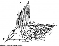 Fig. 12. EEG display ofanother psychic.